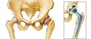 hip replacement surgeons in Thane