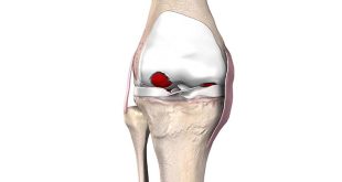 FT-3D knee resurfacing cost in India
