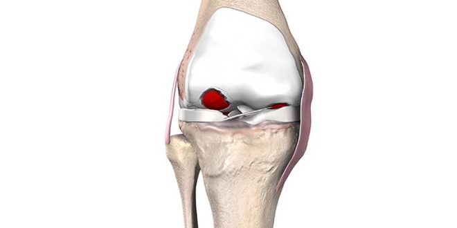 FT-3D knee resurfacing cost in India