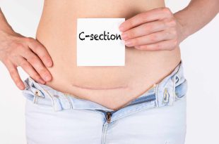 Best Gynaecologist for C-section Delivery in Panchkula