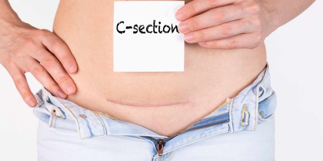 Best Gynaecologist for C-section Delivery in Panchkula